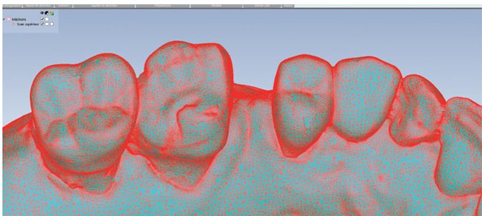 Impression 3D dentaire scanners dentaires